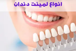 انواع لمینت دندان
