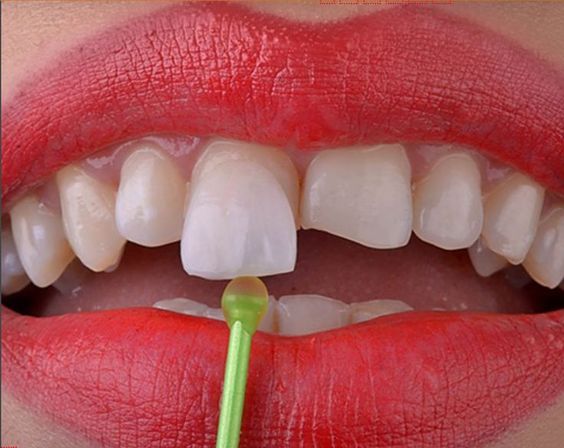 لمینت راه حل مشکلات جدی ظاهری