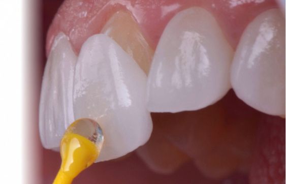 dentist placing a veneer on a tooth