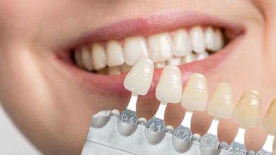dentist preparing a tooth for veneer placement