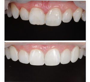 dentist polishing a composite bonding