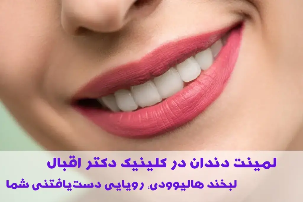لمینت دندان